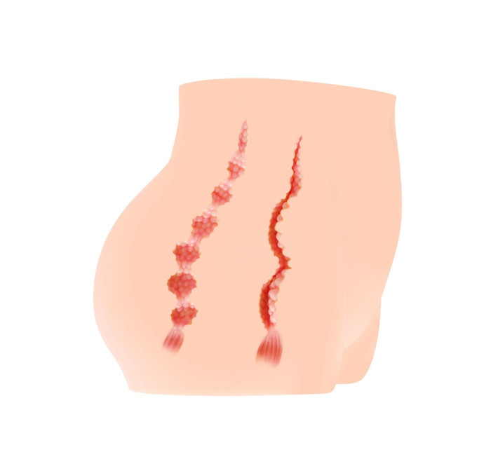 Мастурбатор-полуторс Kokos Cherry, два входа: вагина и попка